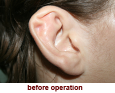 plastic-surgery-prominent-ear 